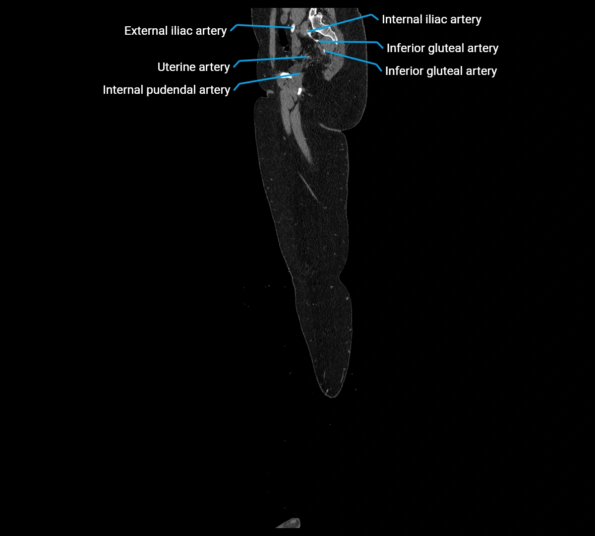 CTA lower limb sagittal cross sectional anatomy labelled image _12 (2).webp